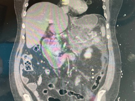 Cystgastrostomy with Stent