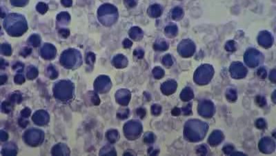 Blood - Leukocytosis