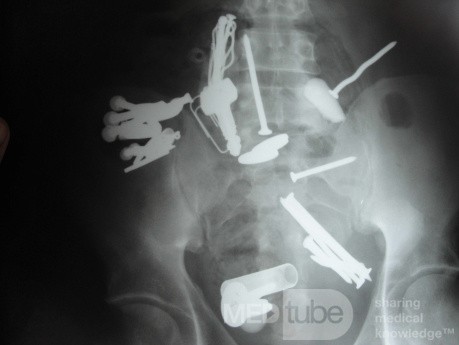 Multiple Foreign bodies in the GI tract (8 of 12)