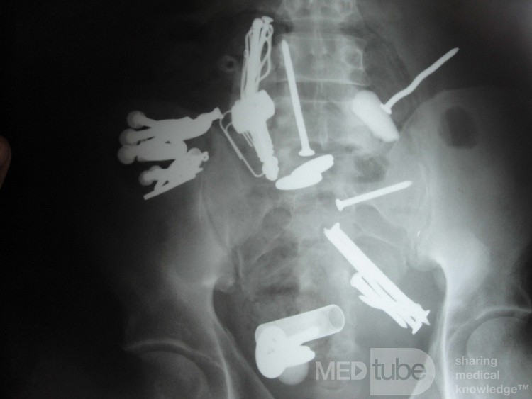 Multiple Foreign bodies in the GI tract (8 of 12)