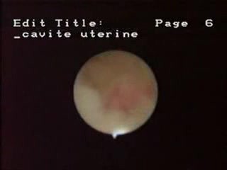 Hysteroscopic Aspect Of Female Genital Tuberculosis
