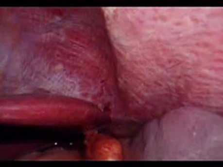 Colonic Perforation With Peritonitis - Laparoscopy (38 of 46)