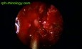 Rec Inverted Papilloma