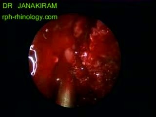 Rec Inverted Papilloma