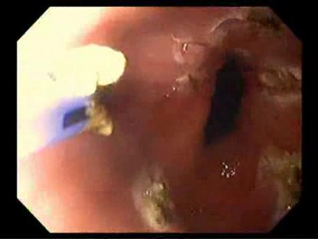 Endoscopy of Mallory Weiss Tear - Status Post Coagulation