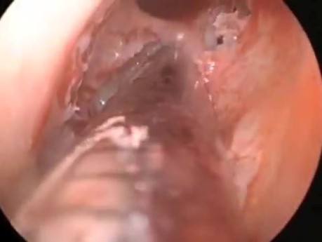 Ethmoidectomy, Polypectomy, Implanting and Stenting
