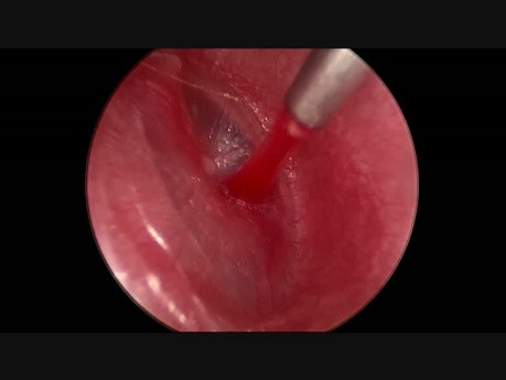 Insertion of Ventilation Tube in Eardrum