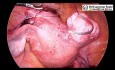 Laparoscopic Myomectomy for Large Broad Ligament Fibroid