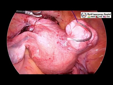 Laparoscopic Myomectomy for Large Broad Ligament Fibroid
