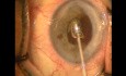 Pupil creation with Fugo plasma blade