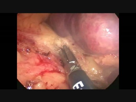 Laparoscopic Splenectomy For Multifocal Splenic Abscesses