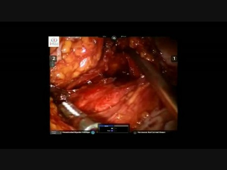 Robotic Redo Mesh Rectopexy