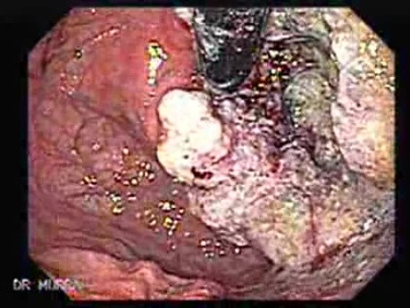 Esophageal Squamous Cell Carcinoma - Precise Assessment of the Tumor