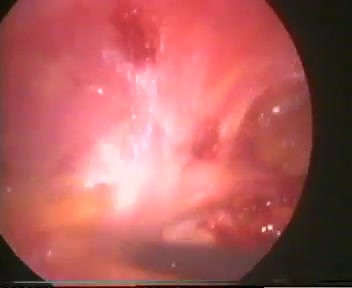 TEP technique in laparoscopic hernia repair