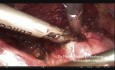 Laparoscopic Repair of Cesarean Scar Defect "Isthmocele" 