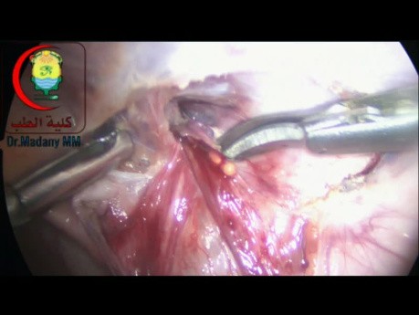 LNs on the Testicular Vein