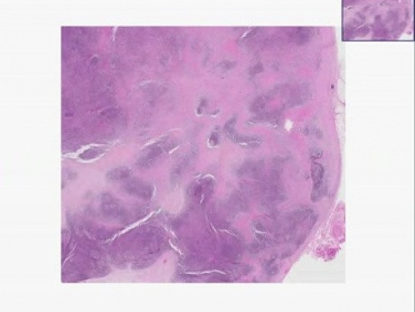 Nodular sclerosis Hodgkin - Histopathology - Lymph node