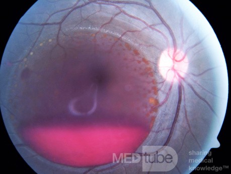 Pre Retinal Haemorrhage