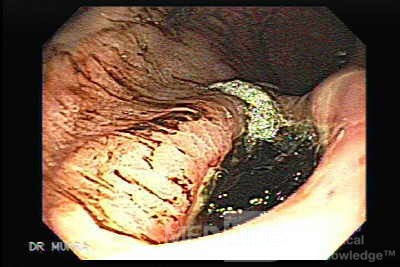 Gastric Cancer - Assessment of Very Deep Ulcer, Part 2
