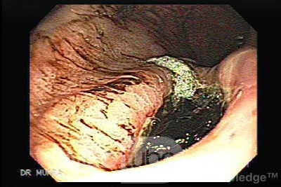 Gastric Cancer - Assessment of Very Deep Ulcer, Part 2