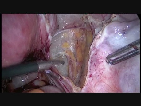 Right Ureterolysis