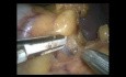 Laparoscopic Splenectomy for the Multiple Aneurysms of the Splenic Artery