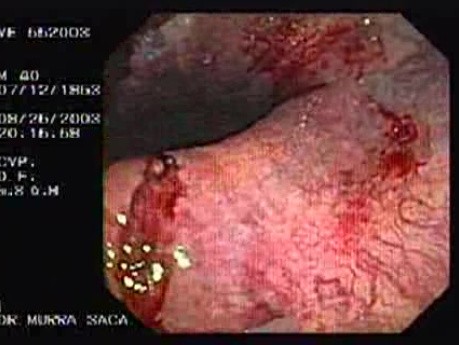 Acute Variceal Bleeding - Erosionated Varix of Gastric Cardia in Retroflexed View