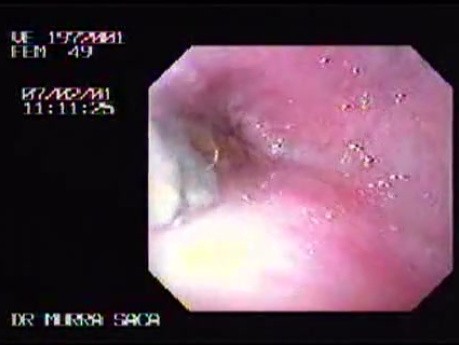 Esophageal Achalasia (1 of 7)