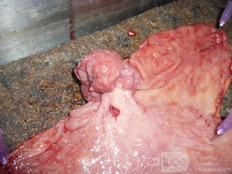 Polypoid Adenocarcinoma (7 of 9)