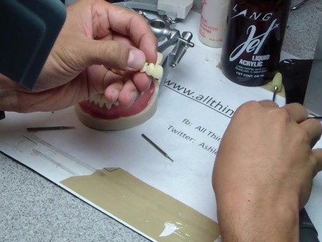 Anterior Bridge Preparation, Part 7 - Hollowing Jet Provisional And I Break It!