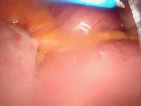 Colonic Perforation With Peritonitis - Laparoscopy (25 of 46)
