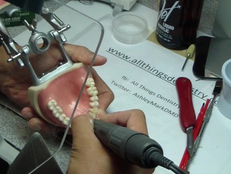 Anterior Bridge Preparation, Part 10 - Jet Provisional Restoration - Finishing Margins Intraorally