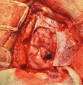 Surgical Planning with Neuronavigator in Patient with Intracranial Mass Lesion. High Grade Glioma.