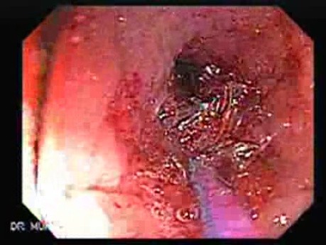 Colonoscopy with Dilation (3 of 8)