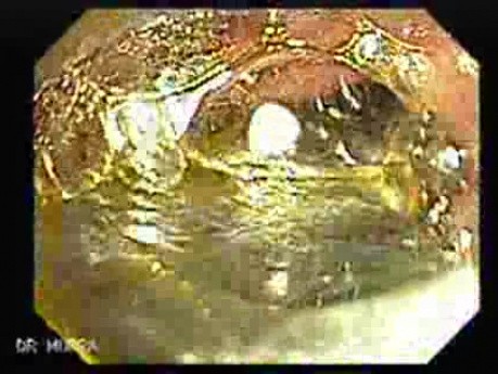 Dental Prothesis Found in the Jejuno (4 of 9)