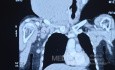 CT of the Neck Show Huge Neck Mass