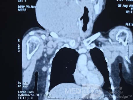 CT of the Neck Show Huge Neck Mass