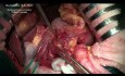 Distal subtotal gastrectomy for stomach cancer