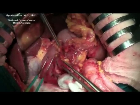 Distal subtotal gastrectomy for stomach cancer