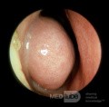 Swollen [vasodilated] Inferior Turbinate [left]