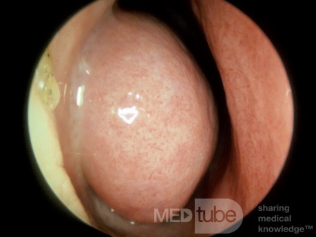 Swollen [vasodilated] Inferior Turbinate [left]
