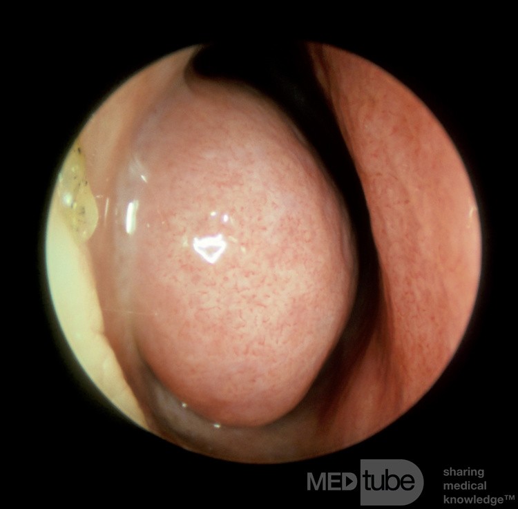 Swollen [vasodilated] Inferior Turbinate [left]