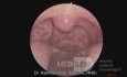 Unilateral Tonsil Enlargement