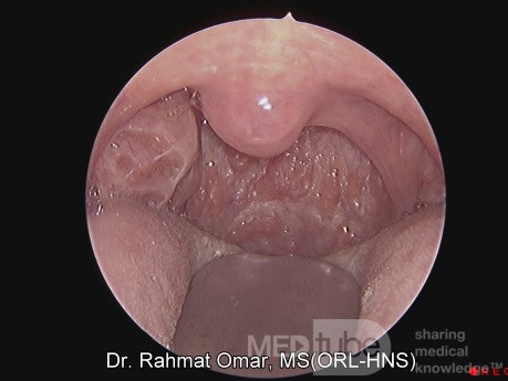Unilateral Tonsil Enlargement