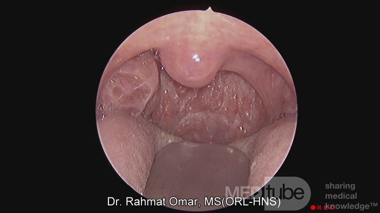 Unilateral Tonsil Enlargement