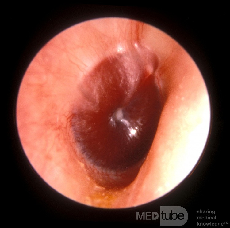 Hemotympanum from Head Trauma