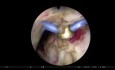 Bipolar Endoscopic Vapo Enucleation of Prostate