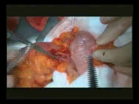 Right Open Hemicolectomy – Technical Principles - Part 5