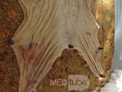 Early Gastric Cancer (11 of 21)