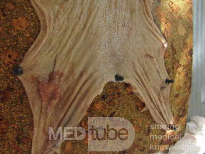 Early Gastric Cancer (11 of 21)